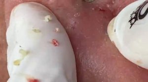 ВЫДАВЛИВАЕТ ПРЫЩИ И УГРИ. СОЧНОЕ РЕЛАКС ВИДЕО давить угри и прыщи