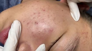250 • Acne collection • АСМР • Relax Spa