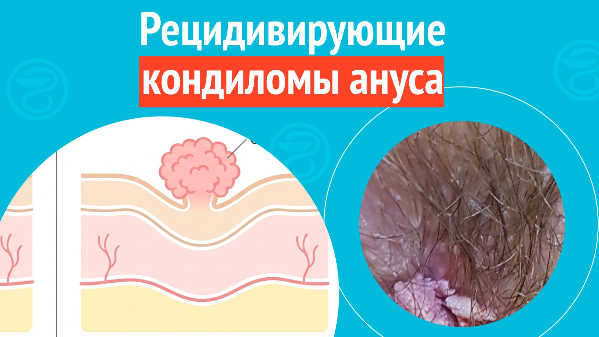 🥺Рецидивирующие кондиломы ануса. Клинический случай №1705 смотреть онлайн