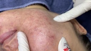 249 • Acne collection • АСМР • Relax Spa