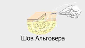 Шов Альговера