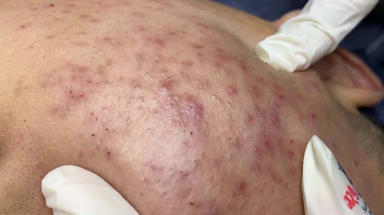 247 • Acne collection • АСМР • Relax Spa смотреть онлайн
