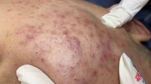 247 • Acne collection • АСМР • Relax Spa