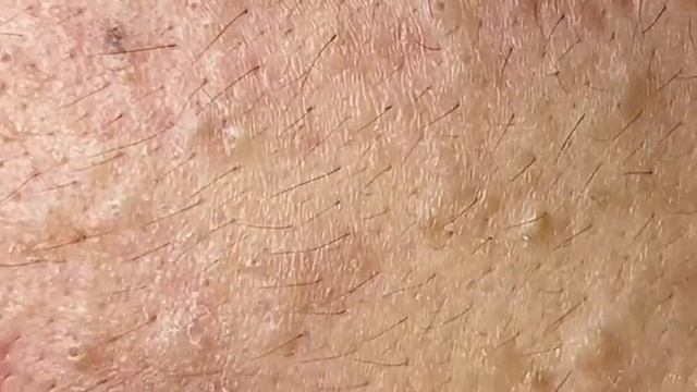 Самые жирные прыщи и угри давить смотреть онлайн