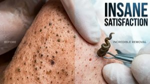 Deep Blackhead and Pimple Removal - Best Satisfying Moments!