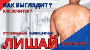 Лечение и профилактика отрубевидного лишая | Как выглядит разноцветный лишай