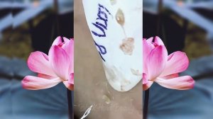 давить угри и прыщи видео давят прыщи и угри
