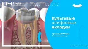 😁 Культевые штифтовые вкладки