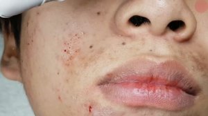 Чистка лица от прыщей и черных точек