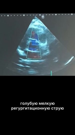 #аортальная регургитация