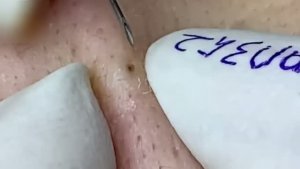 #312 Удаление акне. Экстракция комедонов. Подкожные прыщи. Чистка от черных точек
