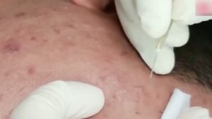 Удаление подкожных прыщей и комедонов на лице