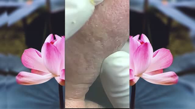 ВЫДАВЛИВАЕТ ПРЫЩИ И УГРИ. СОЧНОЕ РЕЛАКС ВИДЕО давить угри и прыщи смотреть онлайн