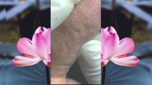 ВЫДАВЛИВАЕТ ПРЫЩИ И УГРИ. СОЧНОЕ РЕЛАКС ВИДЕО давить угри и прыщи