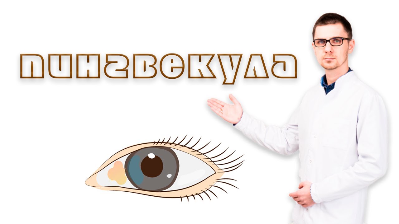 Пингвекула или желтые наросты на глазах смотреть онлайн
