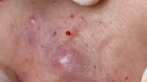 ВЫДАВЛИВАЕТ ПРЫЩИ И УГРИ. СОЧНОЕ РЕЛАКС ВИДЕО давить угри и прыщи