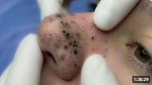 крупные планы и детальная чистка лица