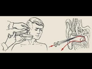 Как правильно промыть ухо от серной пробки дома инструкция