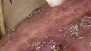 ВЫДАВЛИВАЕТ ПРЫЩИ И УГРИ. СОЧНОЕ РЕЛАКС ВИДЕО давить угри и прыщи