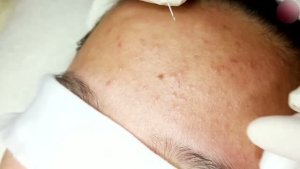 Удаление прыщей и комедонов при чувствительной коже