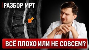 Сложная ситуация: стеноз + спондилоартроз. Разбор МРТ