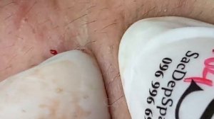 ВЫДАВЛИВАЕТ ПРЫЩИ И УГРИ. СОЧНОЕ РЕЛАКС ВИДЕО давить угри и прыщи