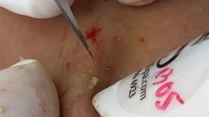 ВЫДАВЛИВАЕТ ПРЫЩИ И УГРИ. СОЧНОЕ РЕЛАКС ВИДЕО давить угри и прыщи