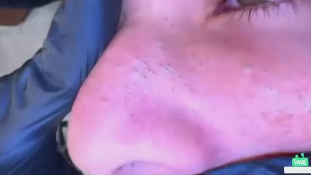 ASMR Blackhead Extraction & Pore Cleaning Relaxing Korean Facial Glass Skin смотреть онлайн