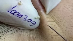 #325 Удаление акне. Экстракция комедонов. Подкожные прыщи. Чистка от черных точек
