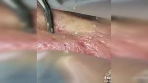 Подборка выдавливания прыщей II выдавливание прыща