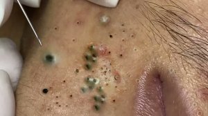 Extreme Blackhead Removal Satisfying Relaxing #946