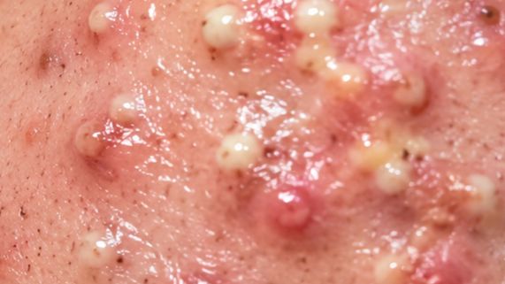 Satisfying Blackheads Removal and Extraction Korean Skincare Routine смотреть онлайн