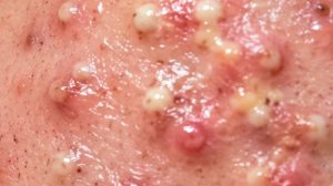 Satisfying Blackheads Removal and Extraction   Korean Skincare Routine