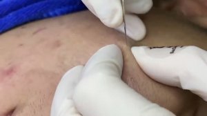 Чистка кожи от прыщей и вросших волос