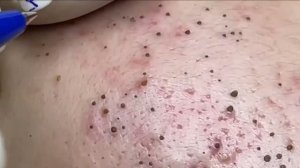 Экстракция прыщей и черных точек — видео для релакса