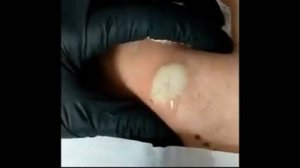 давить угри и прыщи видео давят прыщи и угри давить угри и прыщи новое давить прыщи и угри новое вид