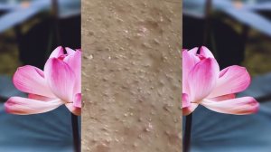 Выдавливание ПРЫЩЕЙ и ЧЕРНЫХ ТОЧЕК!  p27