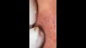 Гигантские прыщи, огромный угри pustules, pimples, blackheads and black dots