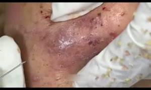 ASMR удаление прыщей и черных точек — расслабляющая чистка лица