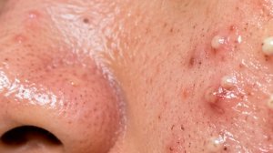 Hana Korean Skincare Routine (For Sensitive Skin, Blackheads Removal)
