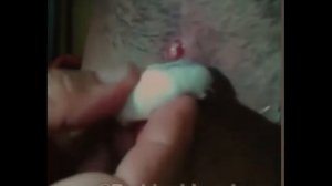 Выдавливание прыщей и гнойников  ЖЕСТЬ