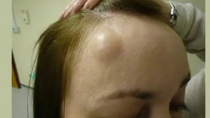 Выдавливание прыщей и удаление черных точек