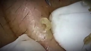 ВЫДАВЛИВАЕТ ПРЫЩИ И УГРИ. СОЧНОЕ РЕЛАКС ВИДЕО