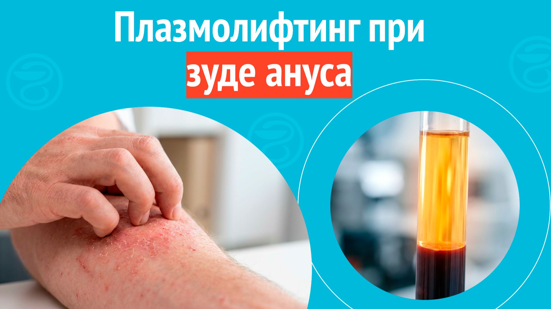 💉 Плазмолифтинг при зуде ануса. Клинический случай №1698 смотреть онлайн
