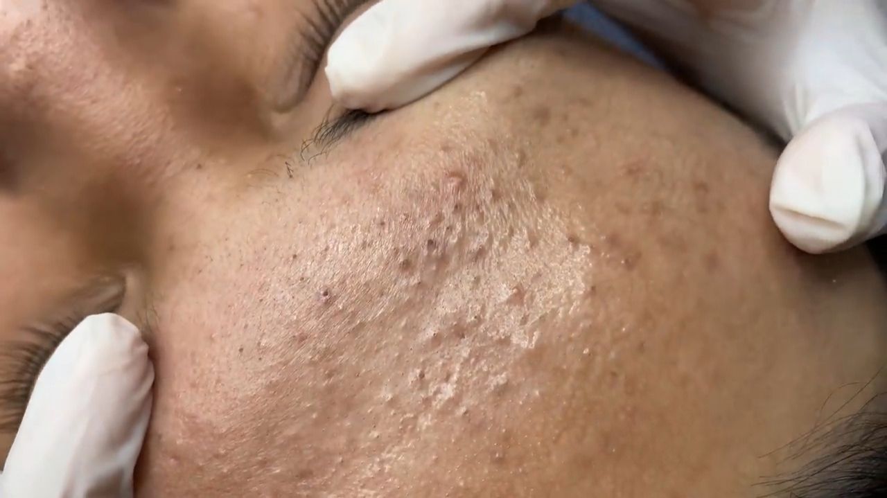264 • Acne collection • АСМР • Relax Spa смотреть онлайн