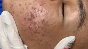 262 • Acne collection • АСМР • Relax Spa