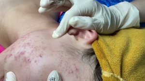 Чистка лица от акне и черных точек — работа косметолога