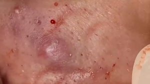 ВЫДАВЛИВАЕТ ПРЫЩИ И УГРИ. СОЧНОЕ РЕЛАКС ВИДЕО