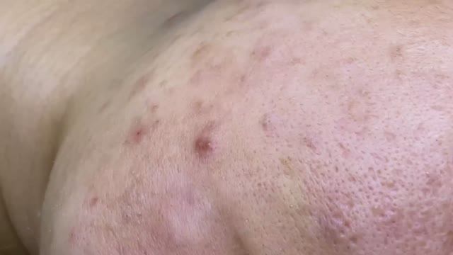 Чистка лица от скрытых подкожных прыщей у клиентки смотреть онлайн