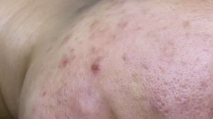Чистка лица от скрытых подкожных прыщей у клиентки
